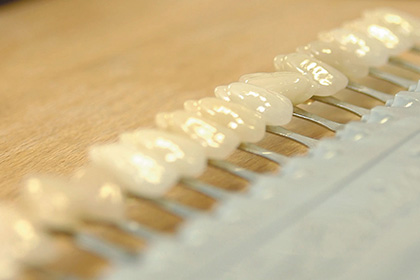 Veneers